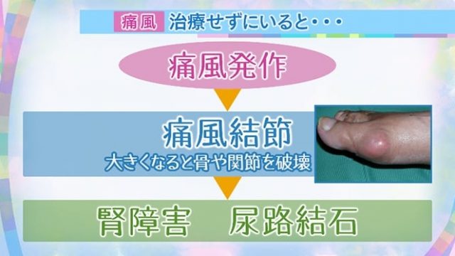 痛風治療をしないとの写真