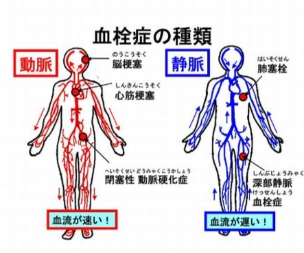 血栓症の種類の写真