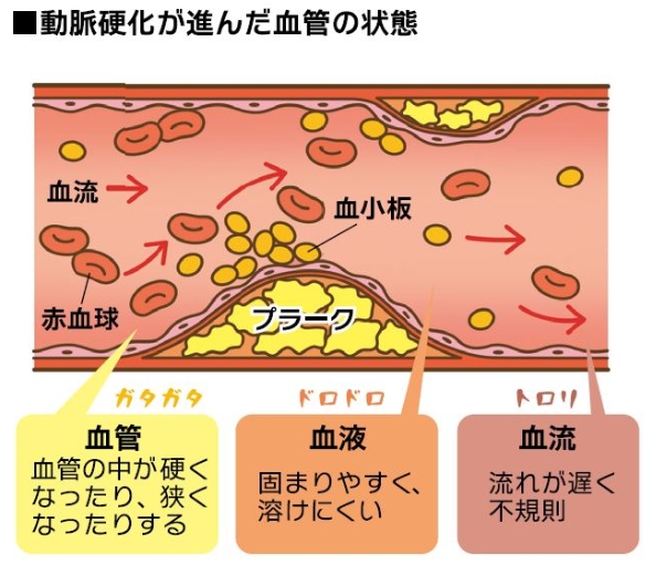 動脈硬化が進んだ血管の状態の写真