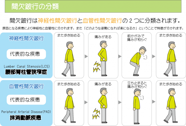 間欠跛行の分類