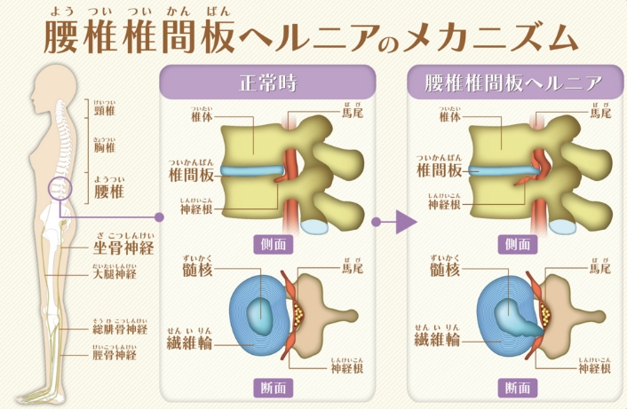 腰椎椎間板ヘルニアのメカニズム