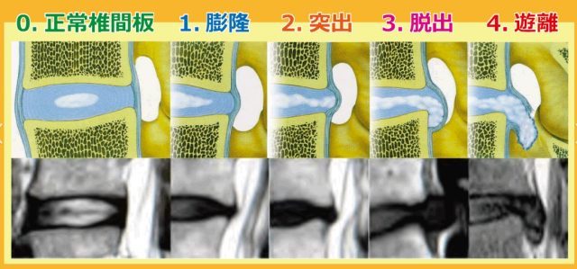 腰椎椎間板ヘルニア形態的分類