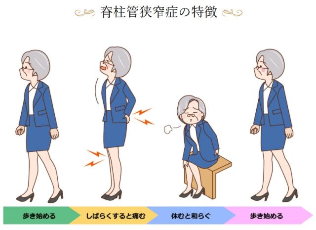 脊椎館狭窄症の特徴