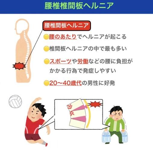 腰椎椎間板ヘルニア