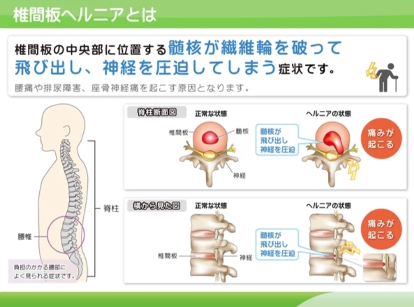 椎間板ヘルニアとは