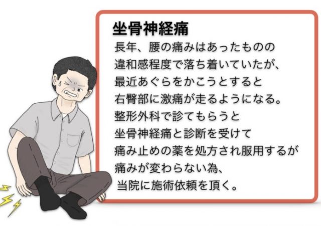 坐骨神経痛