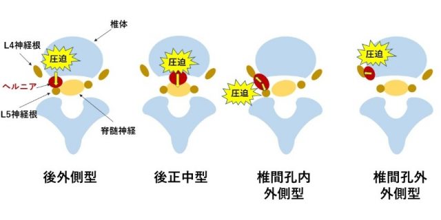 腰椎椎間板ヘルニア横断面における突出形態分類